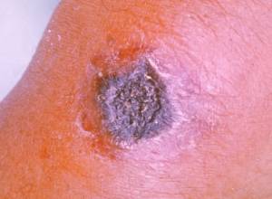 Два случая заболевания Сибирской язвы