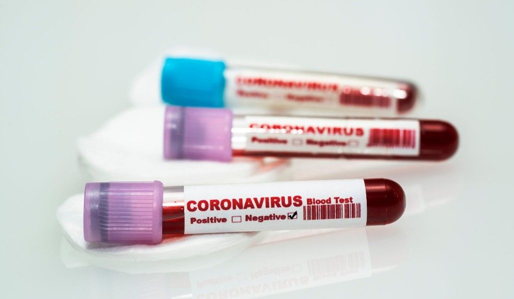 Canva-Coronavirus-blood-test-.-Coronavirus-negative-blood-in-laboratory.-scaled