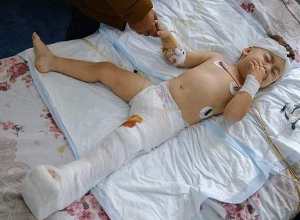 2-летний Арцвик, раненый после тяжелого обстрела, прооперирован