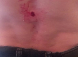 Խրամորթ գյուղի վիրավորված բնակչի վիճակը գնահատվում է բավարար․ ԱՀ Առողջապահության նախարարություն