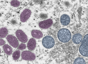 Այսօրվա դրությամբ արձանագրվել է կապիկի ծաղիկ հիվանդության 338 հաստատված դեպք