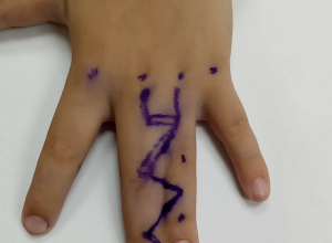 Վերականգնվել է 5-ամյա փոքրիկի մատների շարժունակությունը. բարդ վիրահատություն՝ «Վանաձոր»-ԲԿ-ում