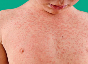 Կարմրուկով 1 հիվանդը կարող է վարակել 12-18 անձի