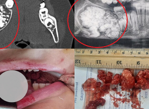 «Սուրբ Աստվածամայր» ԲԿ-ում հսկայական չափերի գոյացություն է հեռացվել երեխայի ստորին ծնոտից