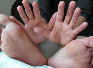 Հայաստանում ժամանակ առ ժամանակ դիտվում է  էնտերովիրուսային վարակներով պայմանավորված հիվանդությունների ակտիվացում