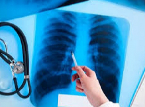 Որն է թոքի քաղցկեղի առաջացման հիմնական ռիսկի գործոնը