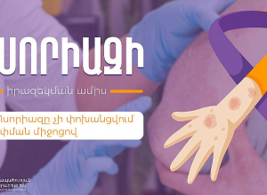 Ի՞նչ է պսորիազը եւ ինչպե՞ս է բուժվում